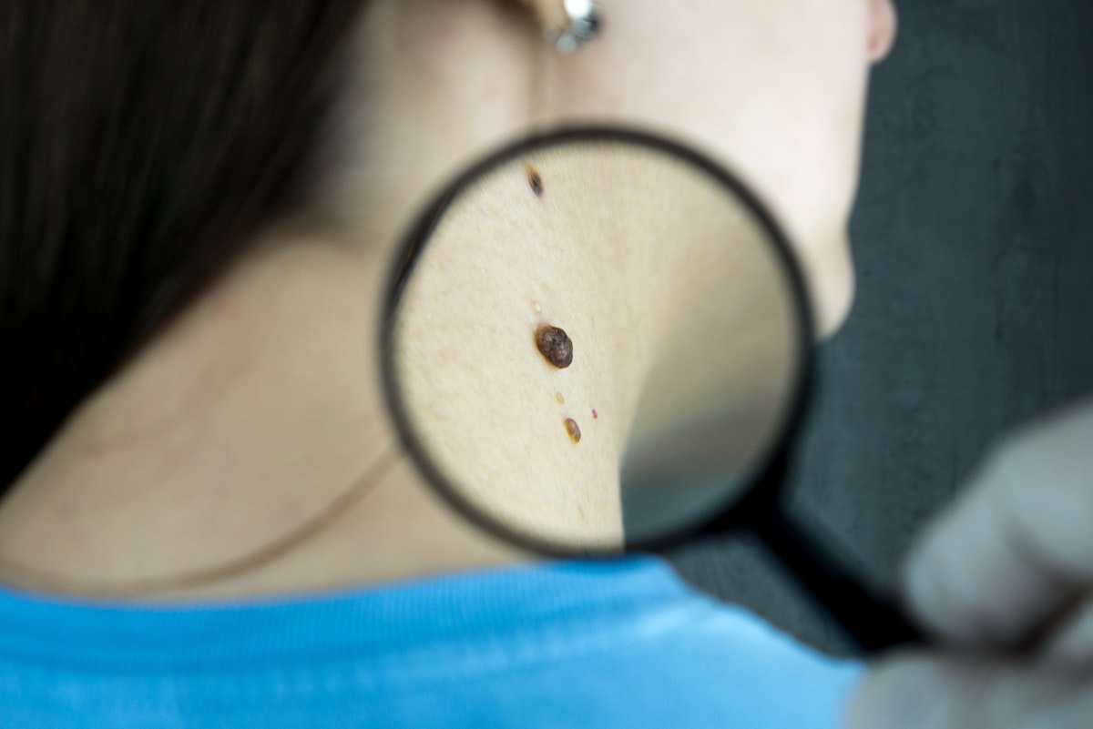 Dermatologin betrachtet ein Muttermal am Hals einer Patientin durch eine Lupe