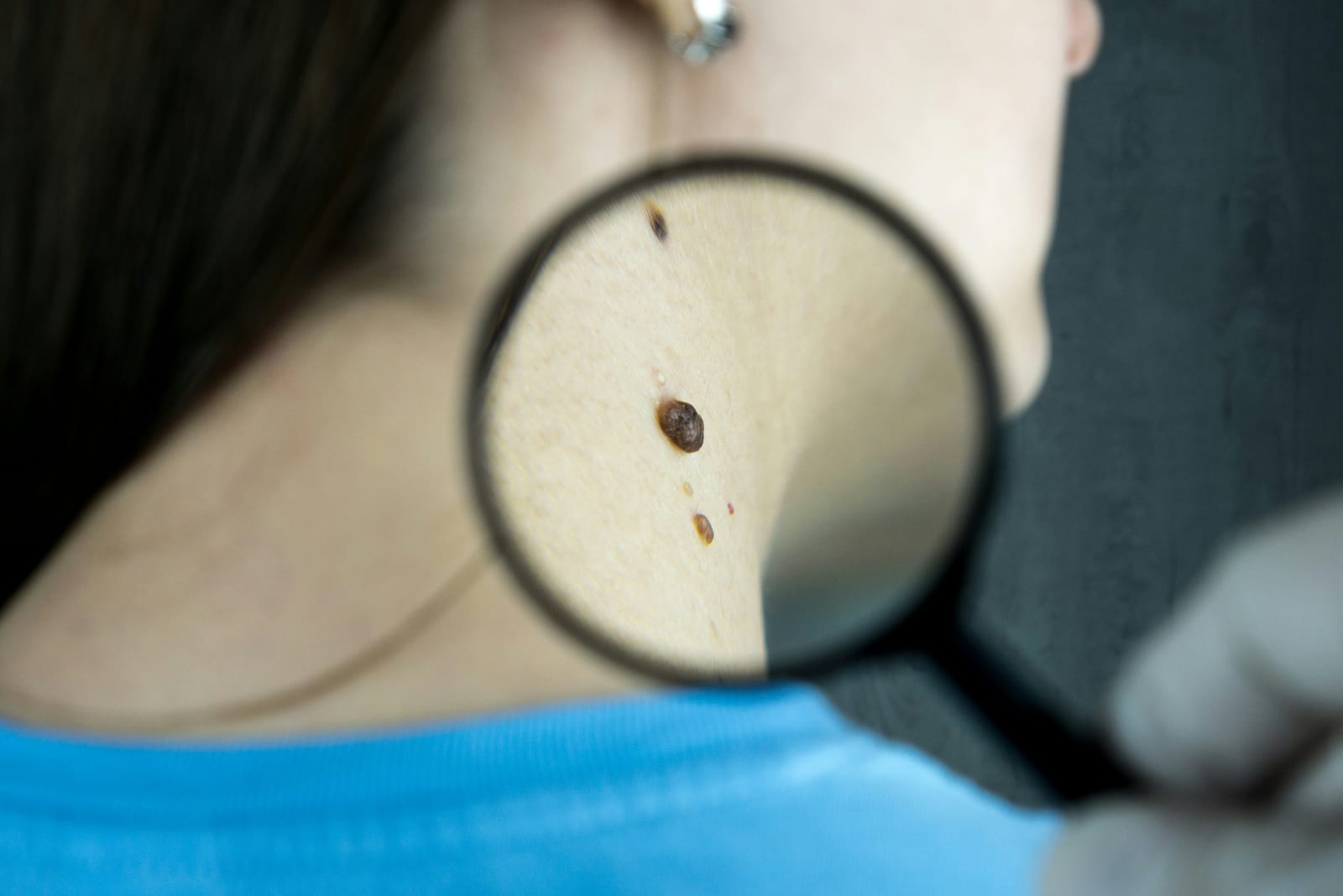 Dermatologin untersucht mit einer Lupe ein Muttermal auf der Haut eines Patienten.