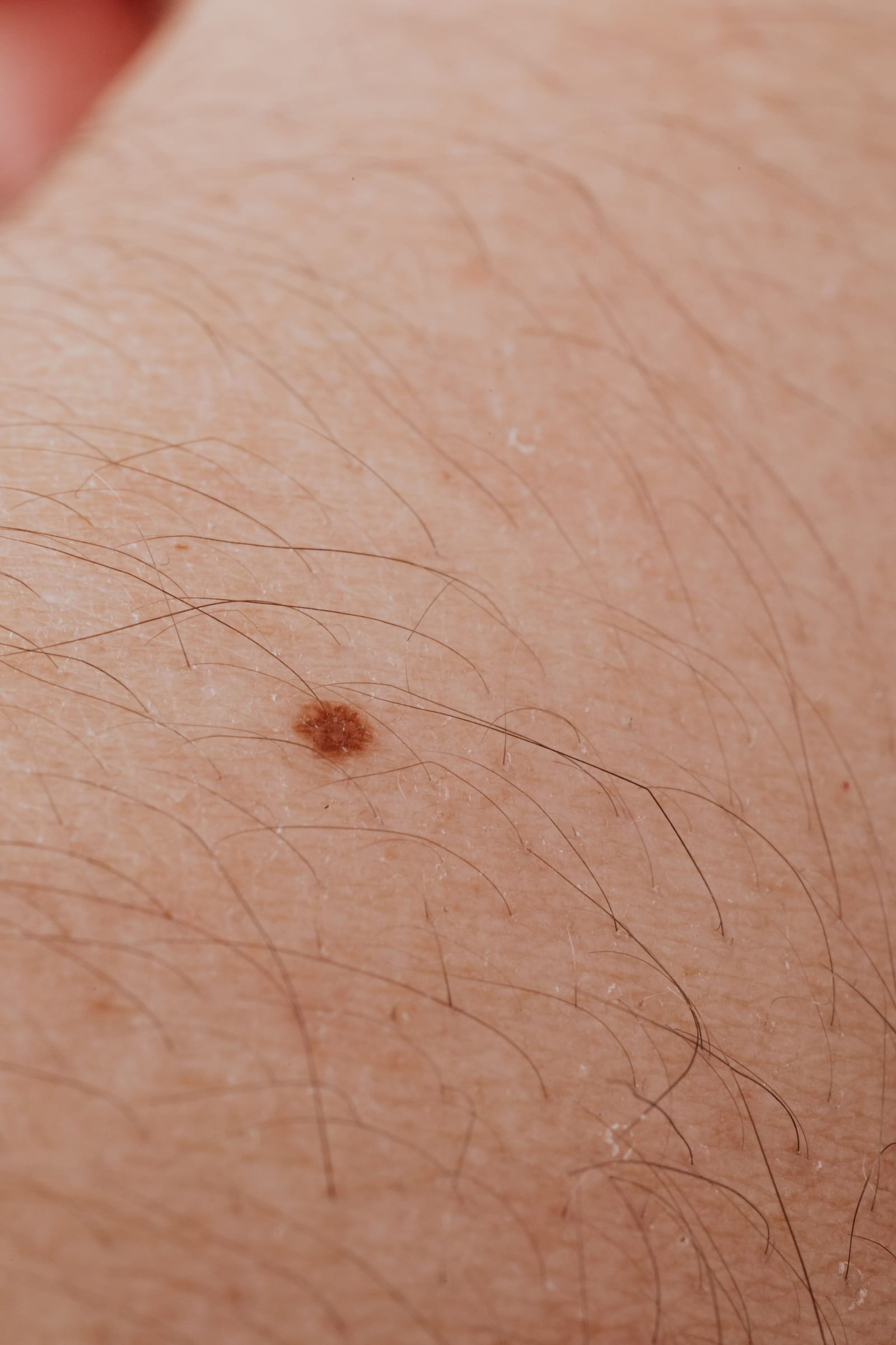 Nahaufnahme eines kleinen, rundlichen braunen Muttermals auf heller Haut – das Erscheinungsbild, das die ABCDE-Regel beurteilt